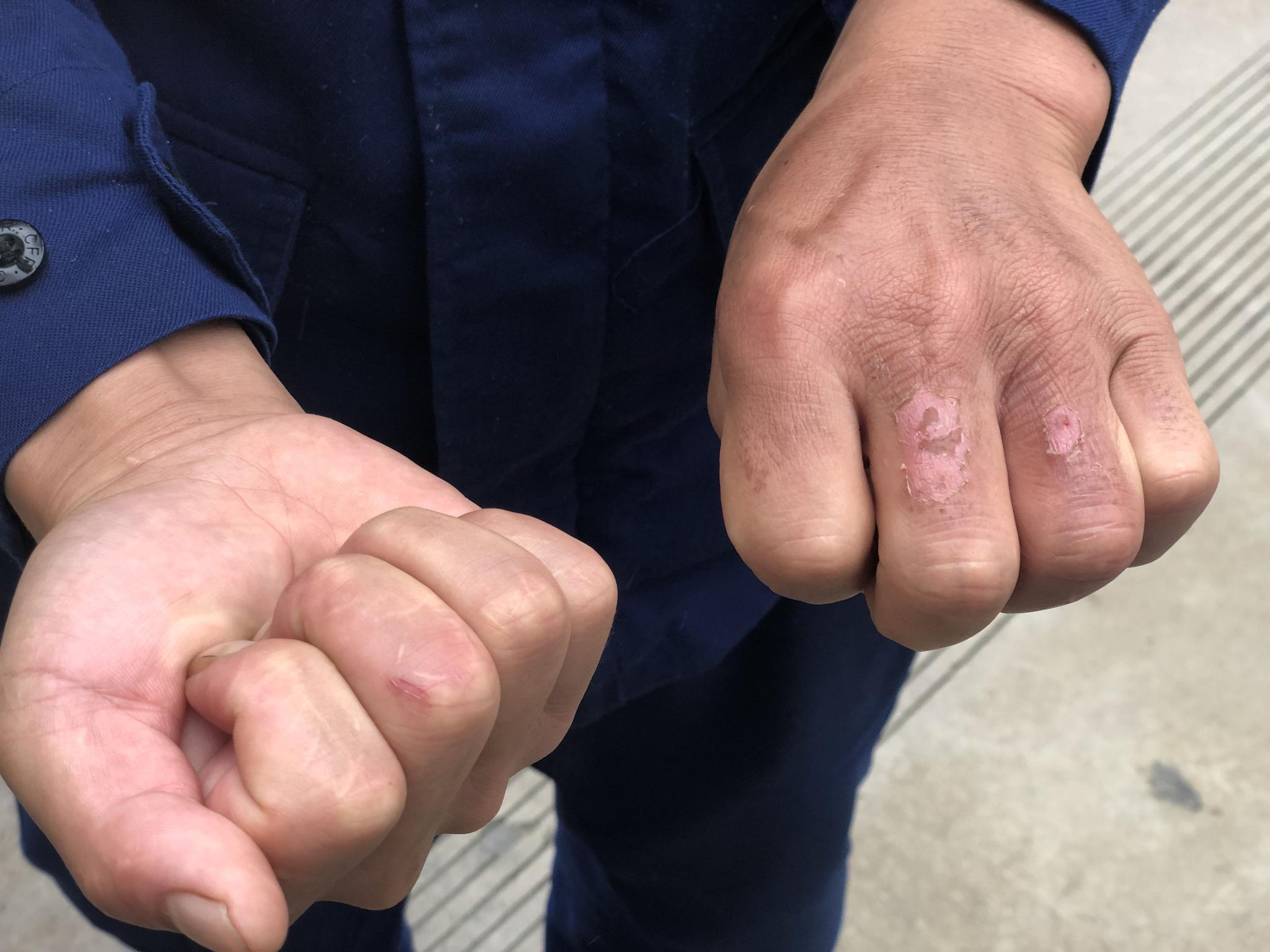 温荣斌展示切菜手上留下的刀疤.摄影/新京报记者 罗晓静