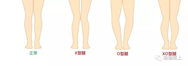 走路姿势不对 导致x型o型腿