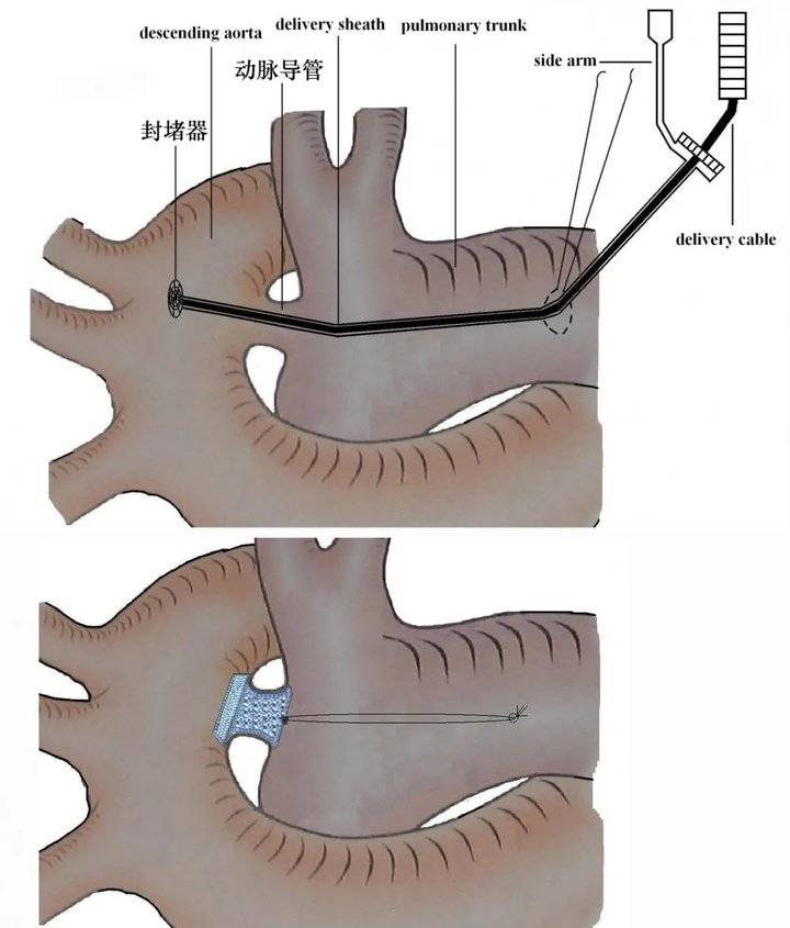 动脉导管未闭 解剖图图片