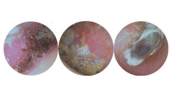 不要盲目掏小伙享受采耳服务后耳朵发霉了