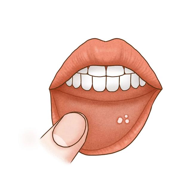 如果出现在舌部,还会出现舌乳头萎缩;如果出现在唇部,还会出现糜烂