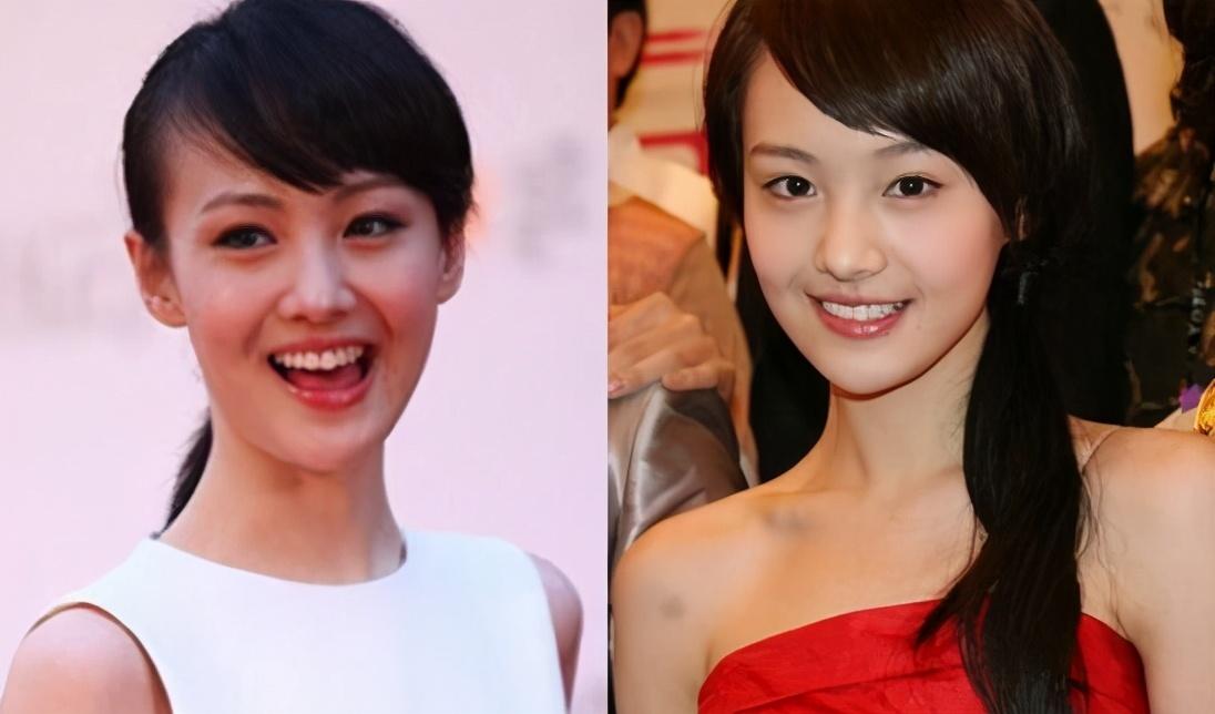 郑爽出现整容后遗症了皮肤暗黄发际线上移嘴角疤痕明显