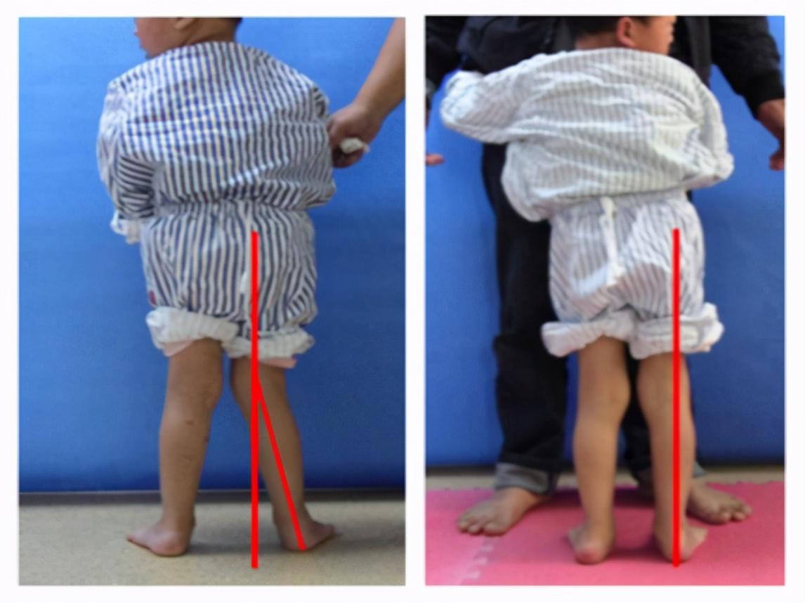 318斤孕妇生下10多斤娃,手术床躺不下,巨大儿危害不容忽视