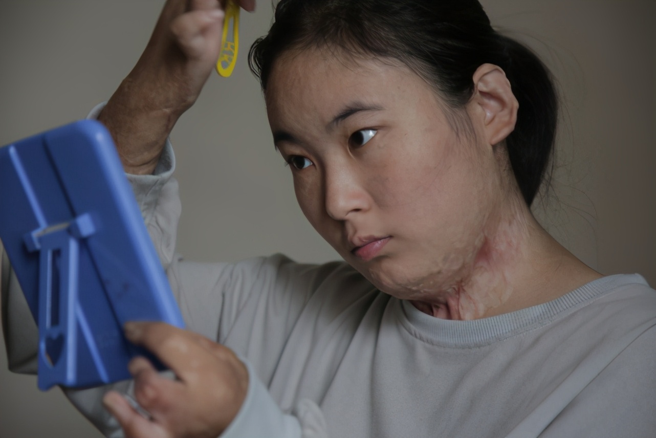 漂亮姐姐火海救弟毁容,1年后重获新生残指弹古筝:最怕吓着别人