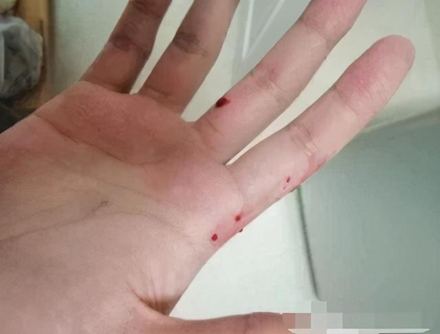 珠海男子被蛇咬,手掌肿了近8厘米厚!关键时刻,绿波及时护航