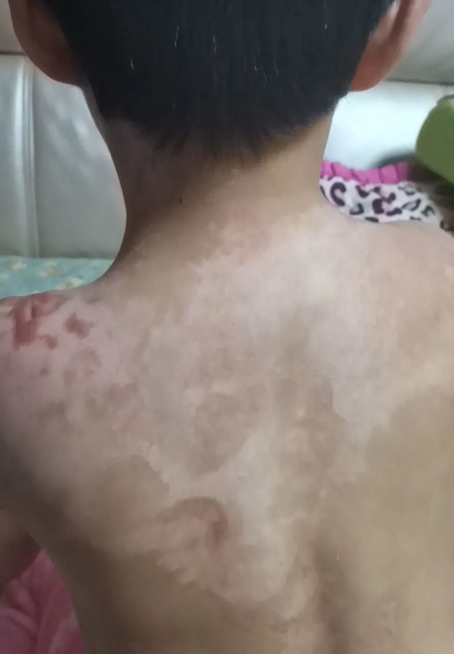 ▲女孩肩膀及背部多处疤痕。受访者供图