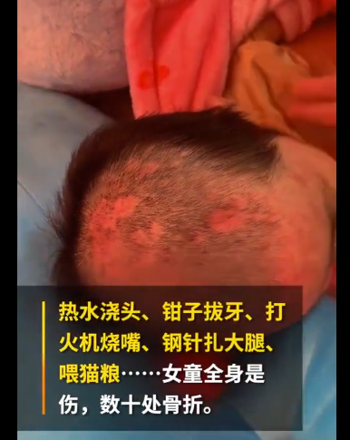 沸水浇头、铁钳拔牙、烧嘴唇...6岁女童被亲妈和男友狂虐3个月 外婆报警还收到死亡威胁休闲区蓝鸢梦想 - Www.slyday.coM