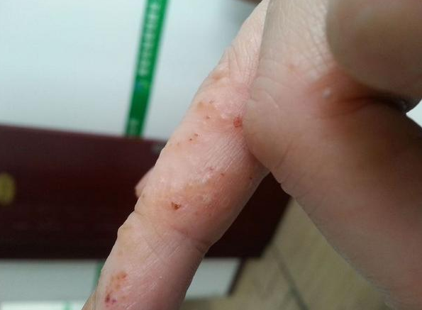 30岁的妇女手上有发痒的水泡,发现出汗的疱疹,是为什么?