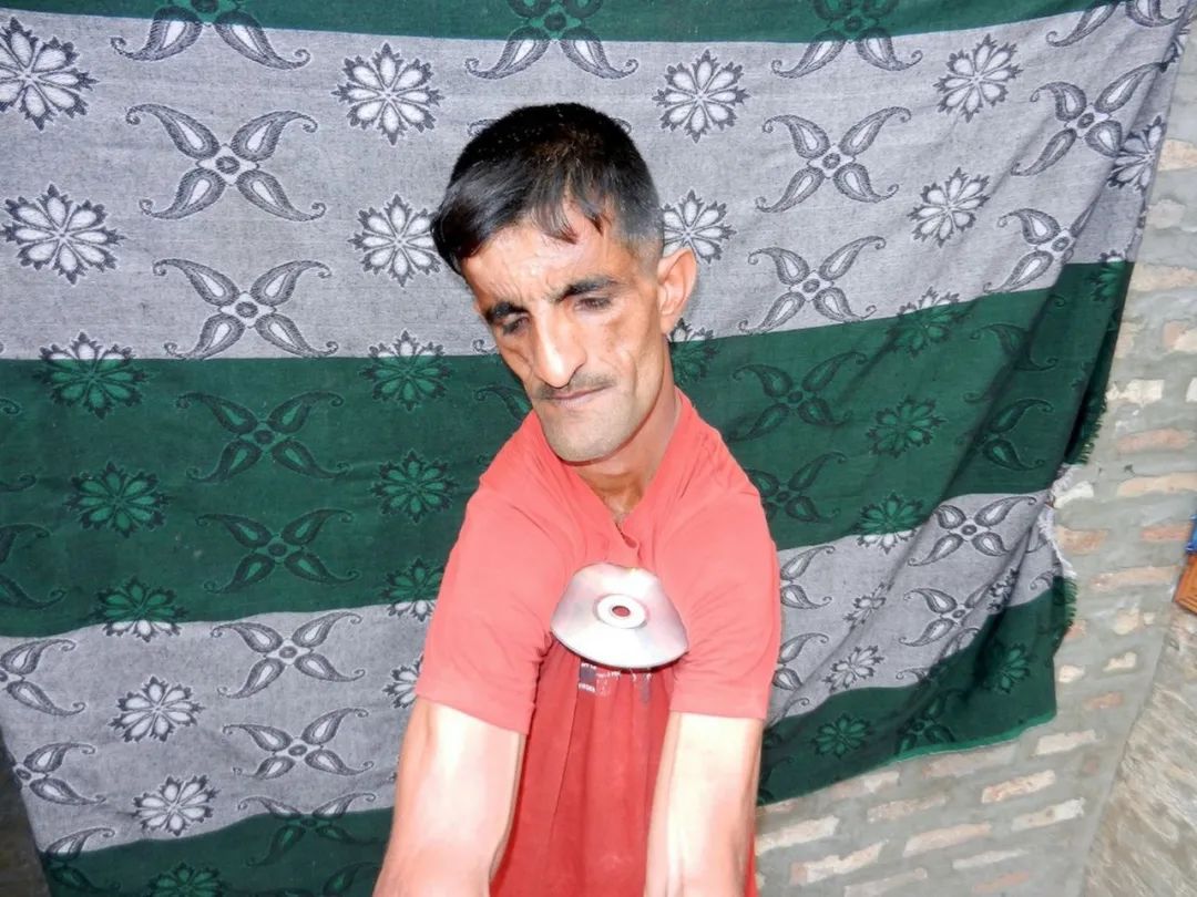 猎奇又真实的橡胶人背后是1天脱臼20次和无尽的并发症