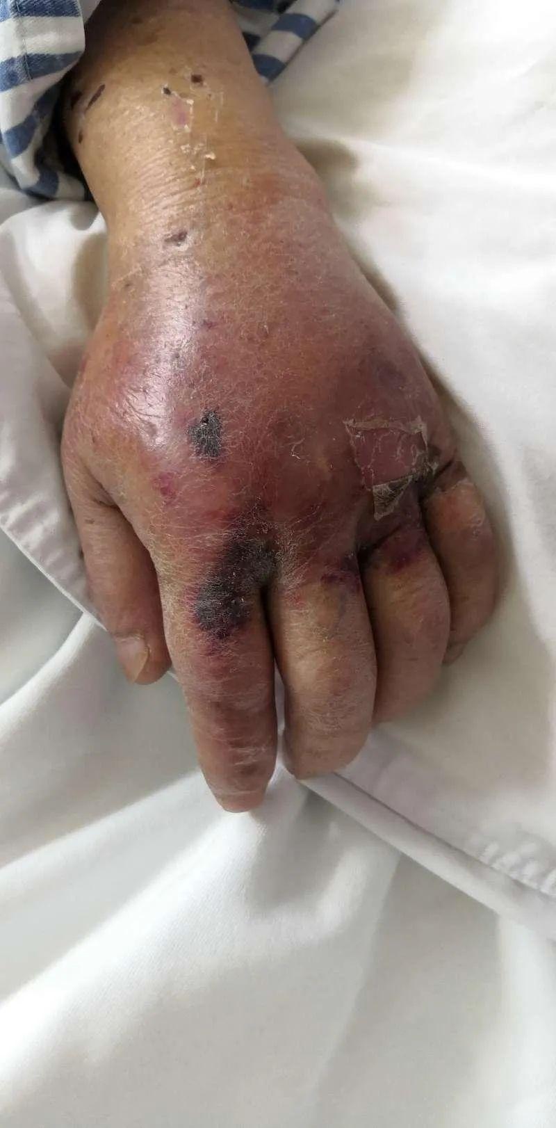 被海鱼刺扎了一下男子险丧命!医生:一旦休克死亡率50%!