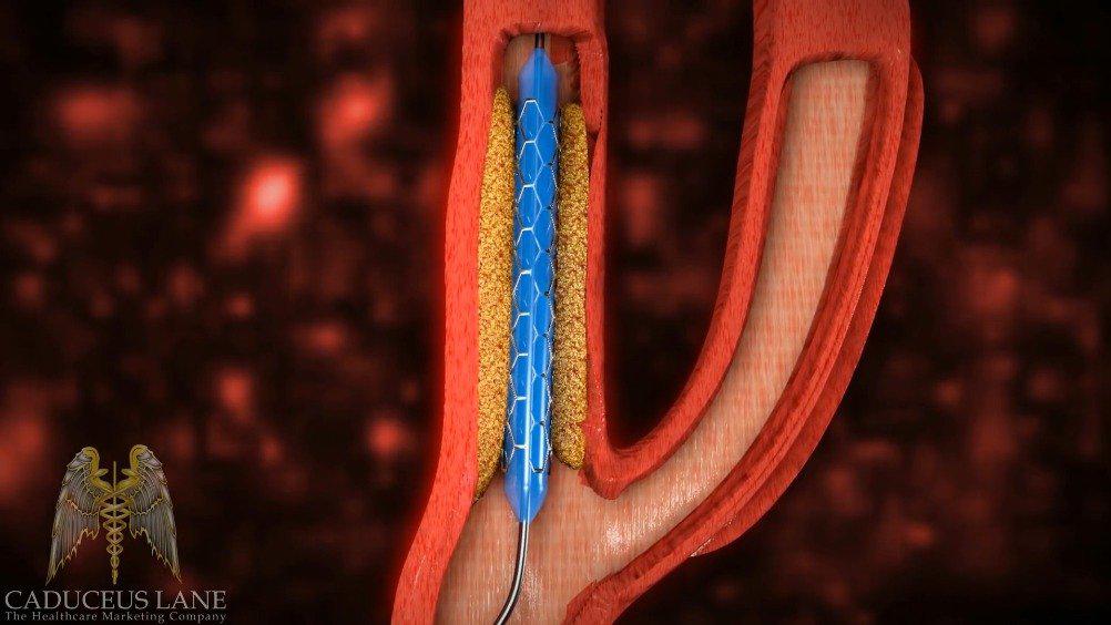 医学动画:颈动脉支架的放置 颈动脉是大脑供血的咽喉要道