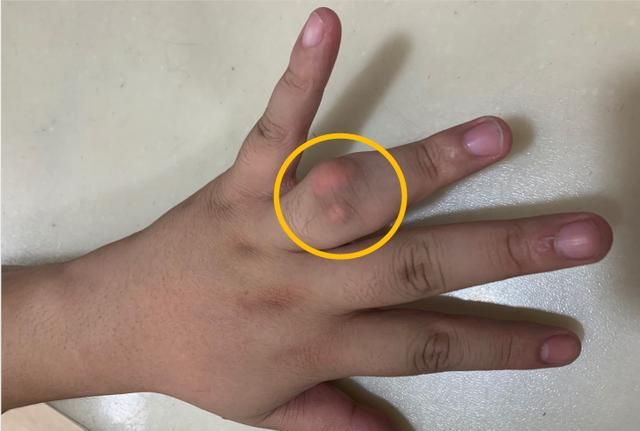 磐安27岁小伙手指长石头两年重了90斤因为这习惯