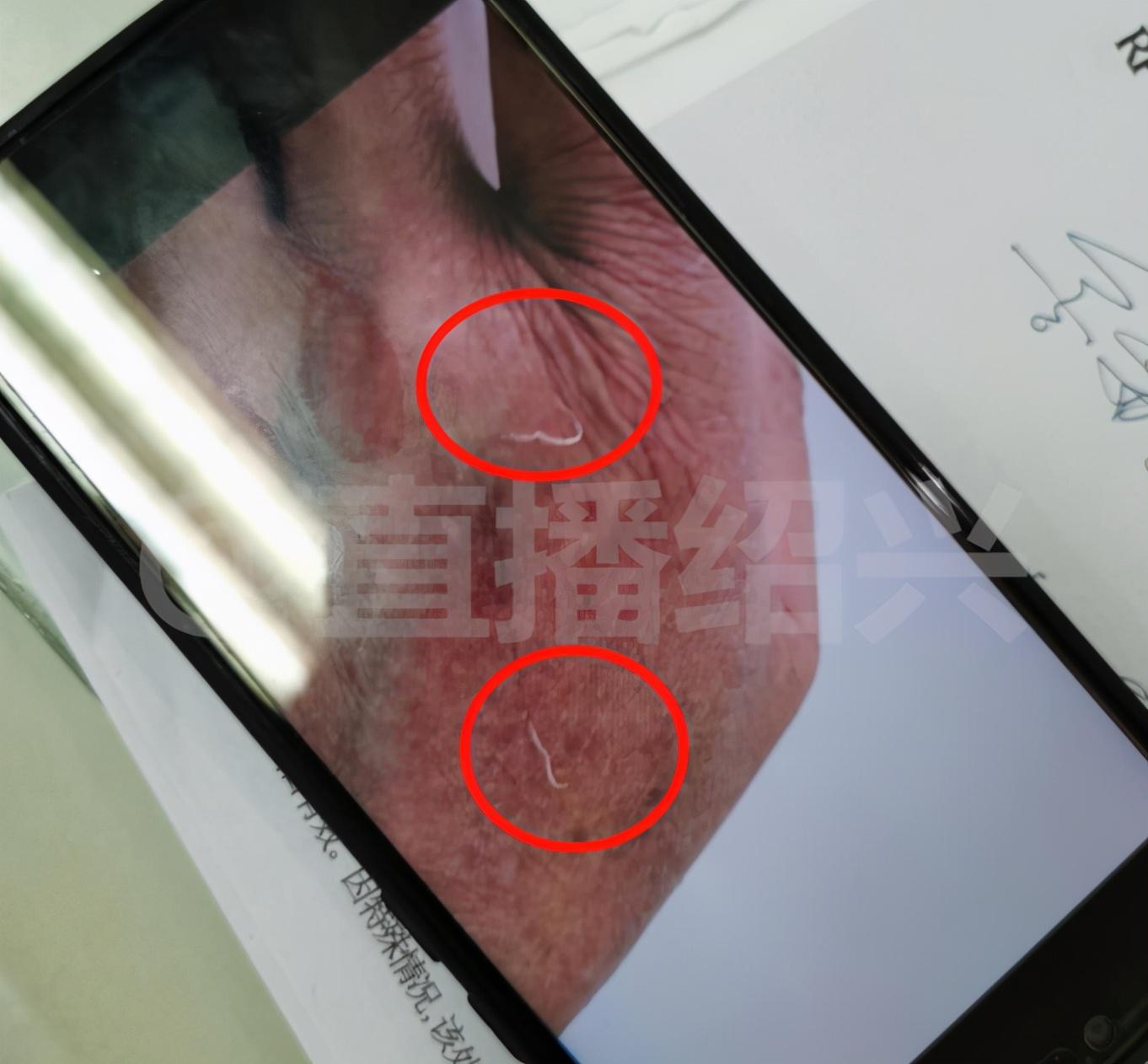 老李的这种情况还是头一次见,她说老李眼中的寄生虫叫结膜吸吮线虫