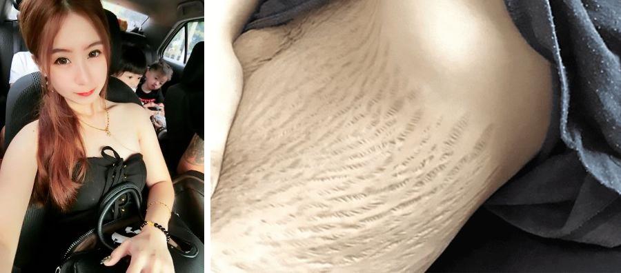 除了妊娠纹,孕期和产后孕妇还可能经历长斑,耻骨痛,腹直肌分离,漏尿