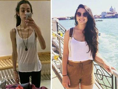 鉴于神经性厌食对健康的危害,我们要从改变以瘦为美的审美做起,体重上