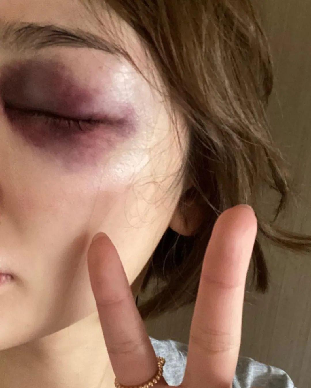 好痛!前tvb"美女学徒"不慎撞伤眼睛伤势严重:真的想哭