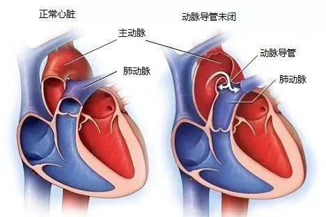 终于确诊先天性心脏病是那几年最令人高兴的消息