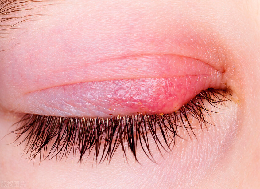 麦粒肿,又名针眼,眼丹,土疡,土疳,因形似针头故名.