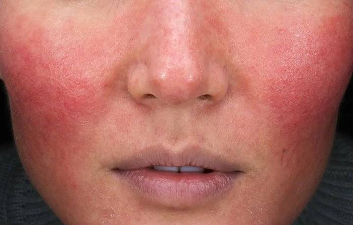 秋冬又出现"红脸蛋",可能是玫瑰痤疮惹的祸__财经头条