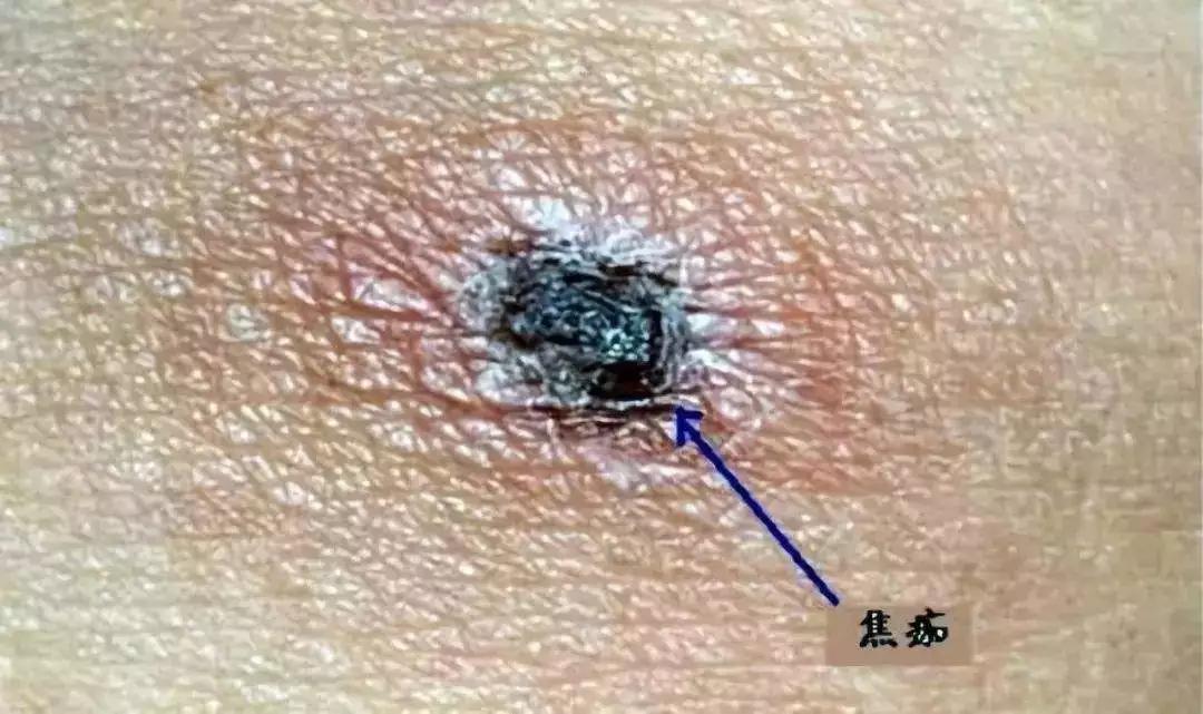 被附近草丛里的恙虫叮咬感染所致医生分析,彭先生可能是钓鱼时医院