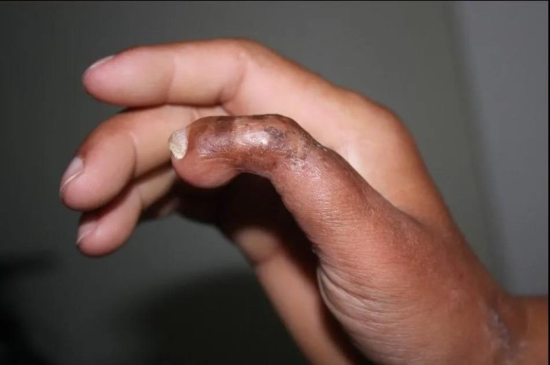 专家科普手指断了怎么办