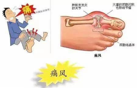 痛风近在咫尺莫做风一样的年轻人