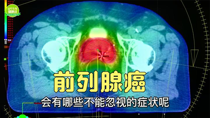 3个异常信号出现,男人要警惕前列腺癌!上了岁数后,一定要留意