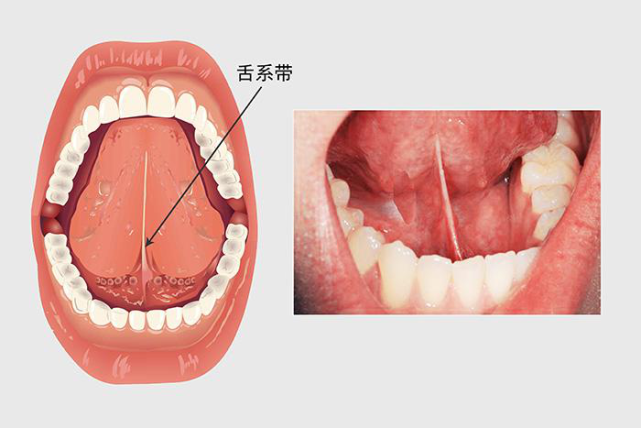 舌系带w形状图片图片