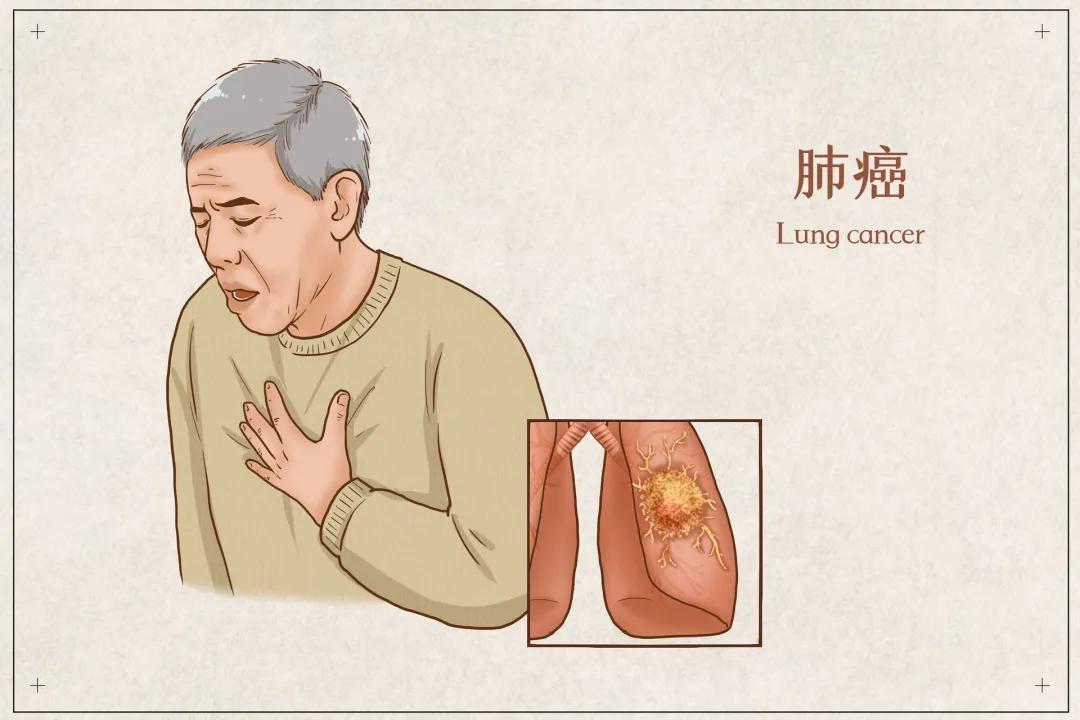国际肺癌日,关爱你的肺,这些知识应知道|肺癌|咳嗽|肿瘤_新浪新闻