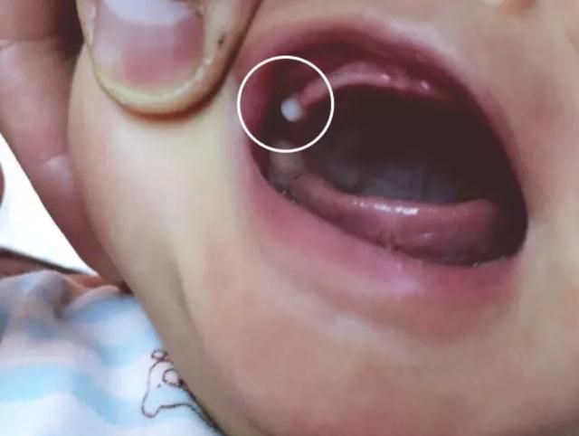 新生宝宝长出"牙齿",是妈妈喂养得好还是天赋异禀?结果打脸