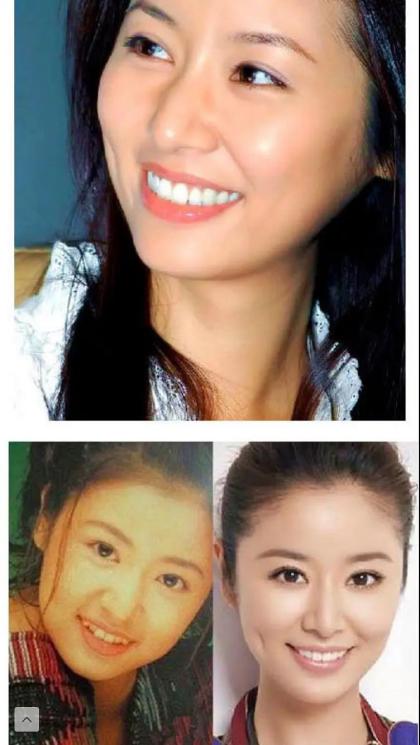 林允陈瑶等明星的烤瓷牙太出戏,做牙需谨慎