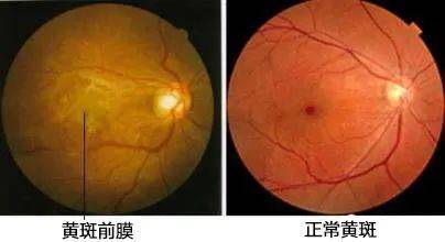 看东西模糊就是"老花"?这种眼病早期症状与老花眼相似