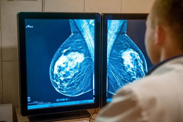 乳腺癌早期包块图片图片