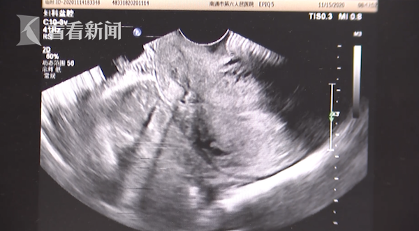视频罕见女子宫内宫外同时受孕鬼门关外走一遭