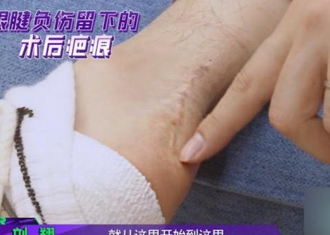 刘翔罕晒跟腱术后疤痕,长达5厘米伤疤触目惊心,网友直呼心疼