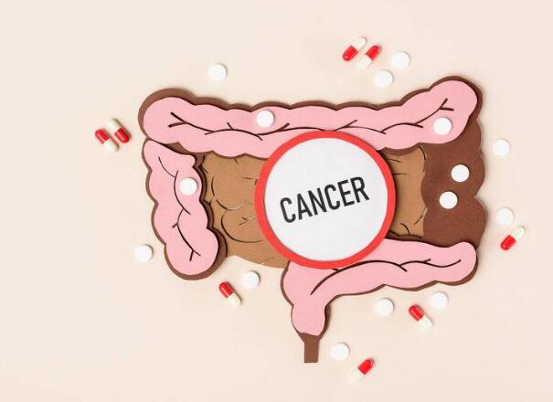 腸癌來襲時,大便早已發出3個明顯信號,若發現,及時做腸道篩查