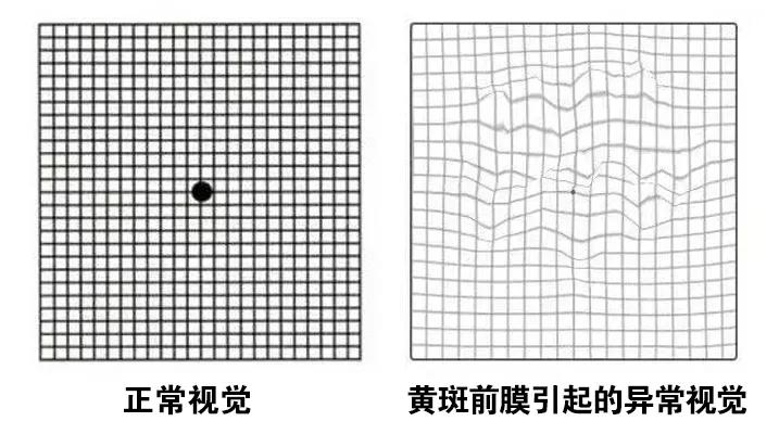 看东西模糊就是老花这种眼病早期症状与老花眼相似