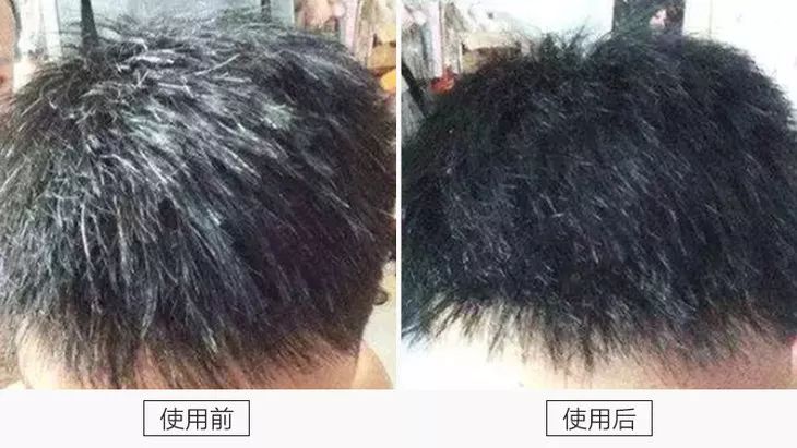 ▲华裔王先生，38岁，衰老性白头，使用乌发还原乳38天效果，头顶的大片白已经逐步减少
