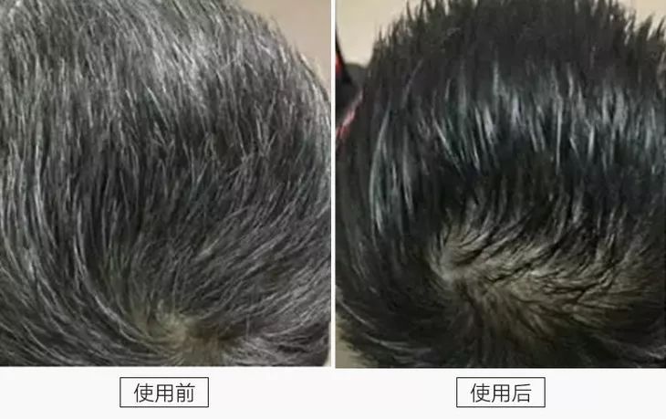 ▲新西兰留学生鹏鹏，28岁，天生少年白，使用黑发还原乳60天后头发乌亮