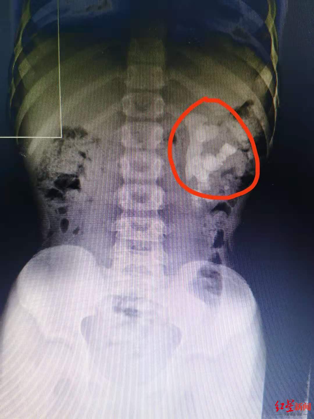 惊呆!6月龄男婴输尿管下段被结石堆满 这是怎么回事?|结石|输尿管|患