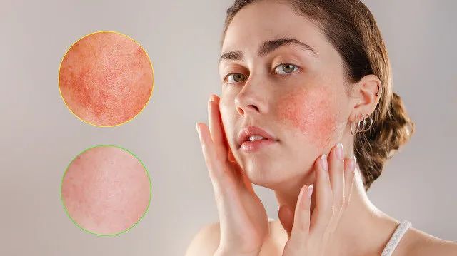 皮肤敏感必看关于敏感肌你的理解可能是错的