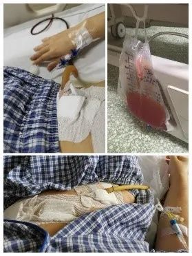 医生笑呵呵地说:"做了快4个小时啊,我手到今天都疼,你这炎症太重了