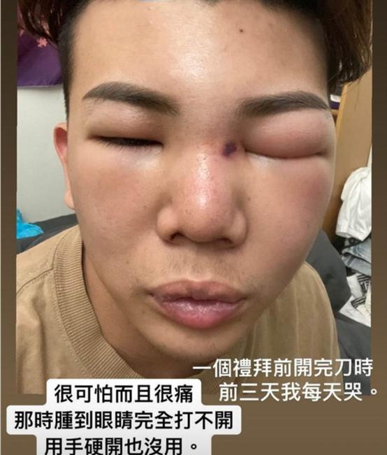 男星整形失败肿成猪头鼻子发臭有固定女友还约见上百位女网友