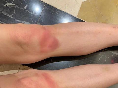 小s晒双腿淤青照,为助阵蔡依林好卖力,穿透视装大秀s曲线身材