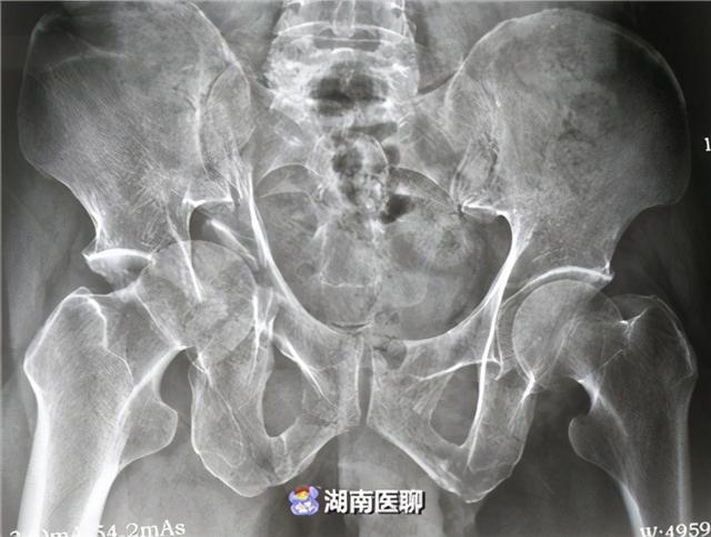 六旬大爷从高处坠落,致髋臼粉碎性骨折!这家医院妙手置换