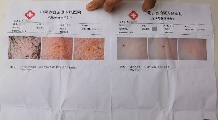 孩子的检查报告单上,可清晰看到针眼.