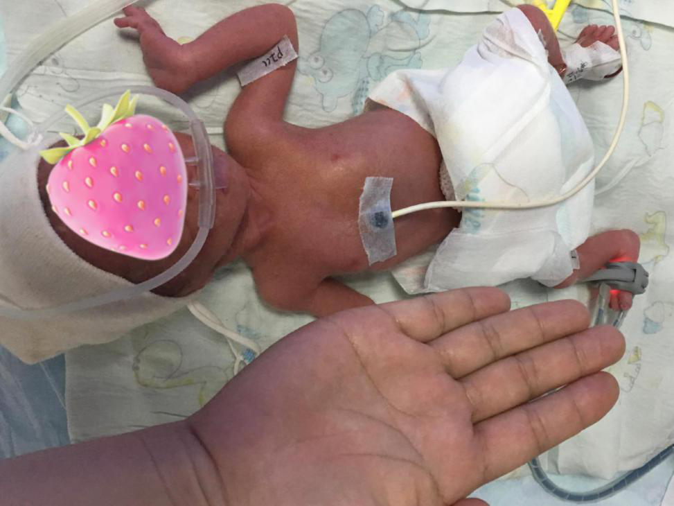 奇迹!刷新河南记录,体重500克巴掌宝宝顺利出院