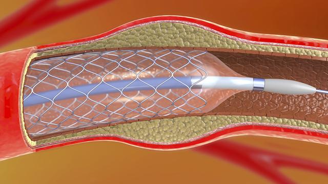 价格降至千元以下 国家组织冠脉支架集中招标采购报价工作结束
