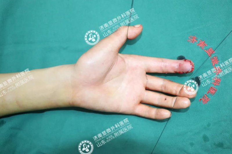 受伤2个月的食指终于健全!3d全形手指再造术助患者恢复自信