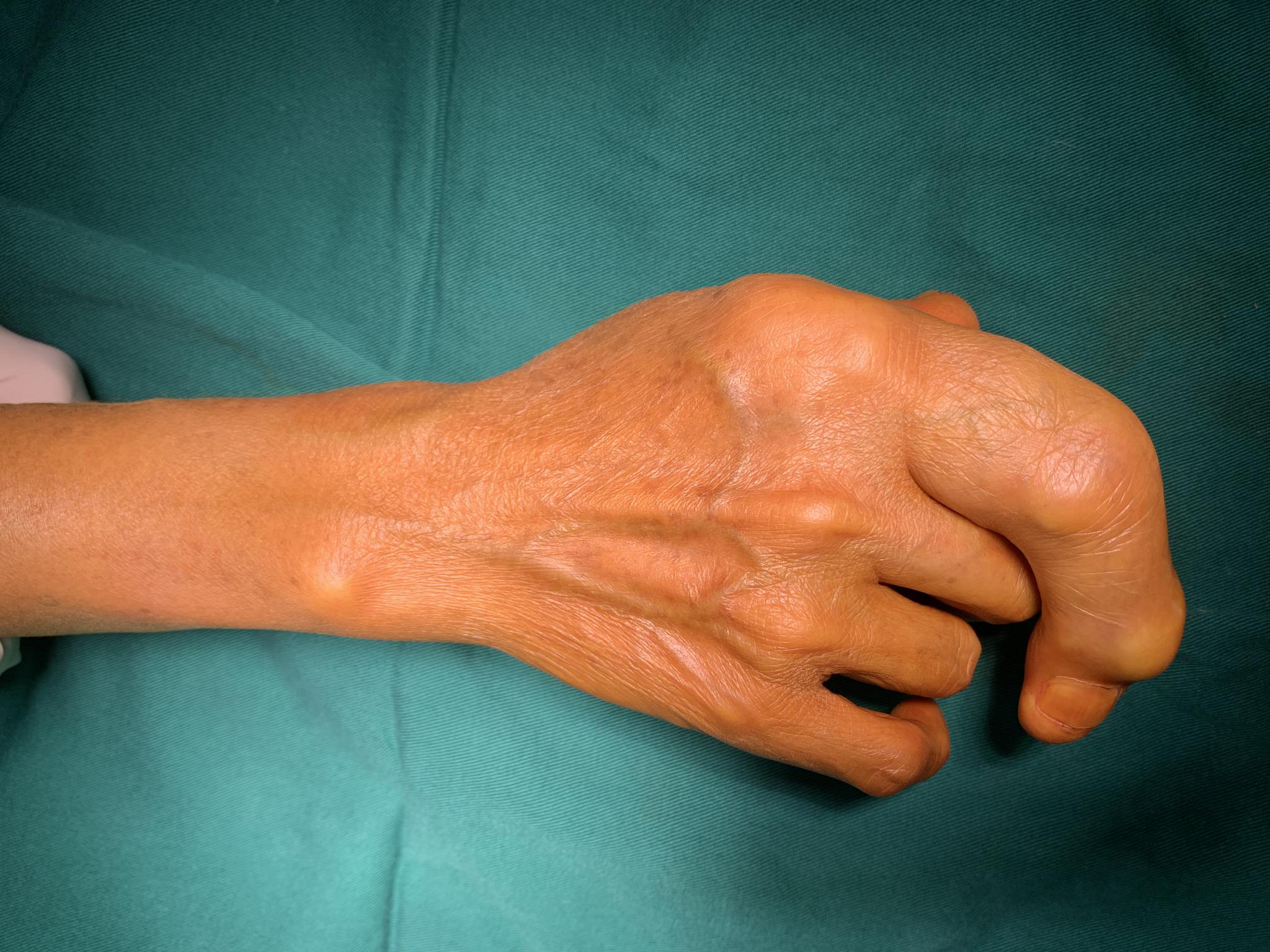 罕见巨指症困扰50年,今朝妙手回春笑颜开!|骨科_新浪新闻